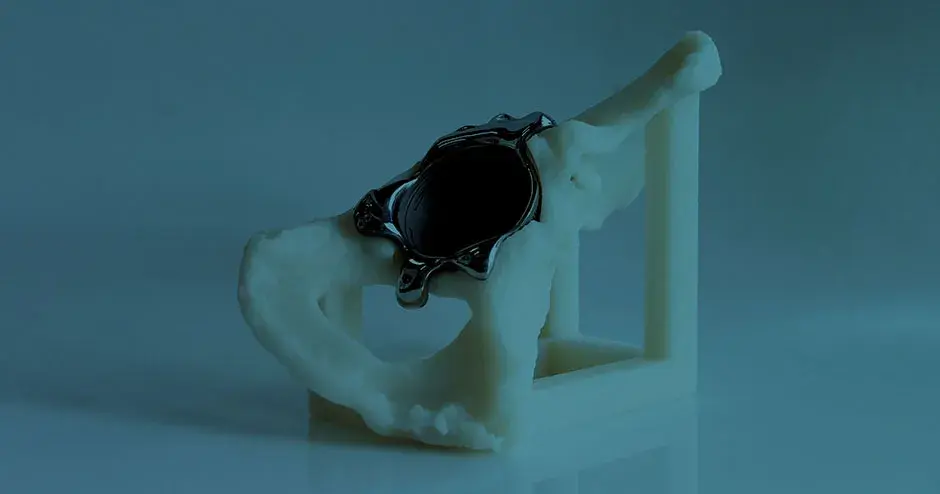 3D 打印金属制造的医疗模型