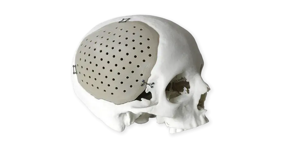 PEEK 颅骨植入体