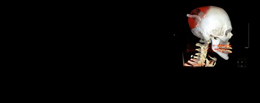 A cranial plate