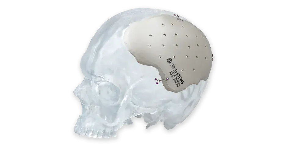 A 3D printed Cranial Implant